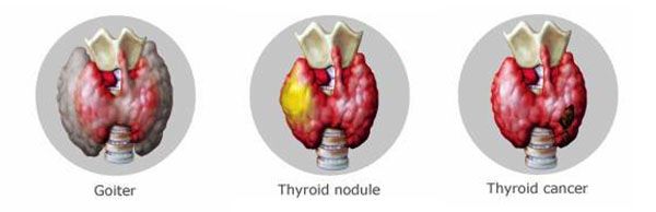 Merck Inc.'s Thyroid Disorder Awareness